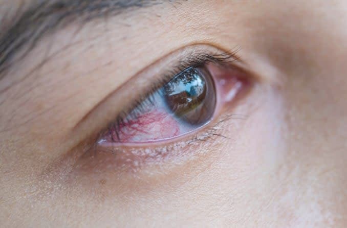 Close-up image of eye with conjunctivitis