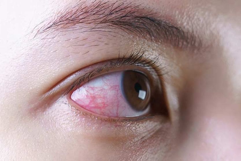 Kích ứng mắt do nhiễm trùng