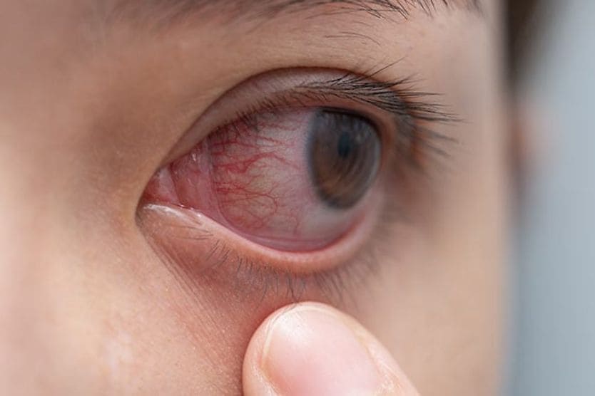 Người đó kéo mí mắt xuống để lộ mắt đỏ bị kích thích