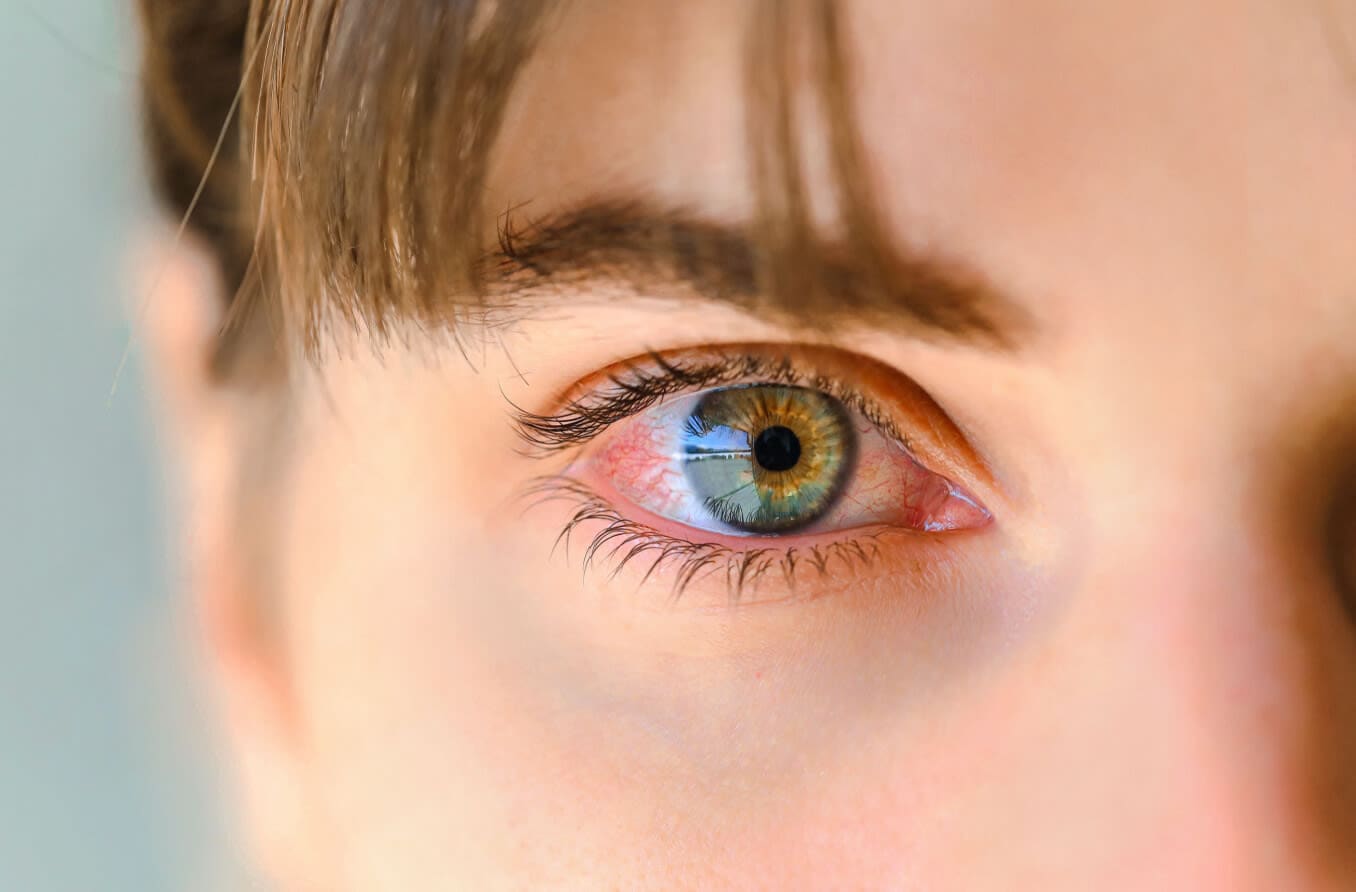 Close-up of woman's pink eye.