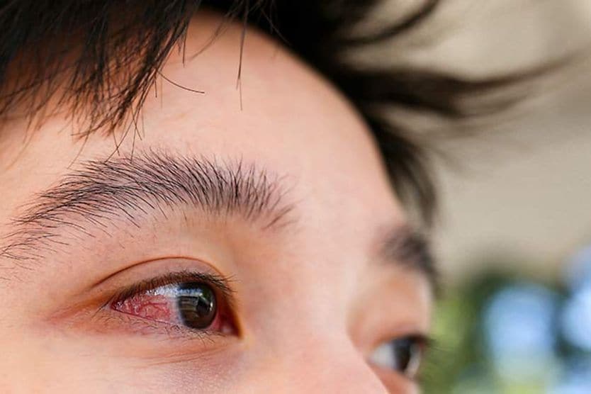 Cận cảnh một người bị viêm kết mạc (mắt đỏ). Cận cảnh một người bị viêm kết mạc (mắt đỏ).
