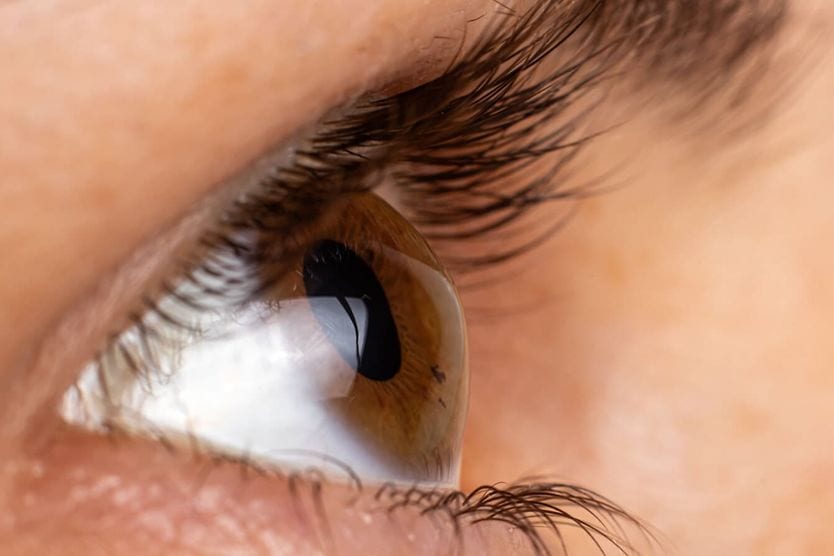 keratoconus keratoconus