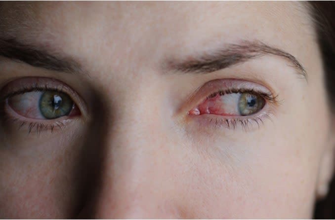 Close up of woman with pinkish-red eyes