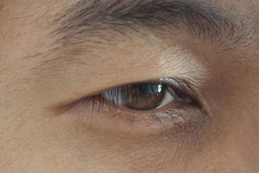 người bị sụp mí mắt do bệnh ptosis người bị sụp mí mắt do bệnh ptosis