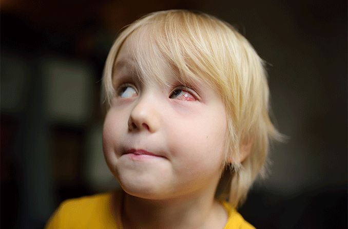 boy with vernal conjunctivitis