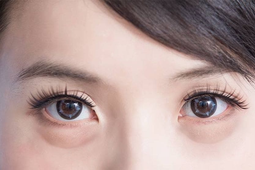 Người phụ nữ có đôi mắt sưng húp Người phụ nữ có đôi mắt sưng húp