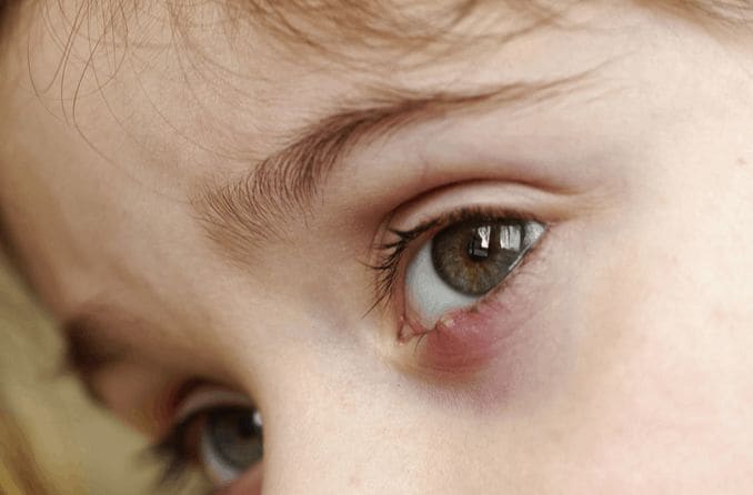 Close up of a child's eye with a stye