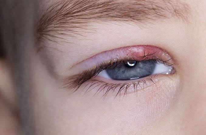 Boy with a stye in his eye