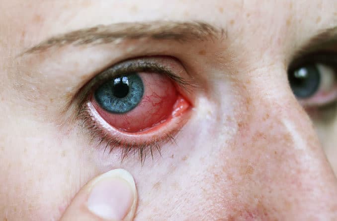 Uveitis, iritis and eye inflammation