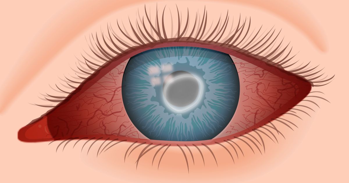 illustration of Acanthamoeba keratitis