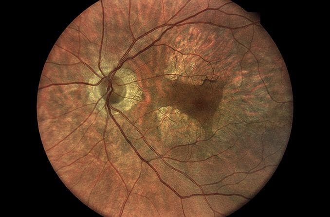 Congenital macular dystrophy on the left eye