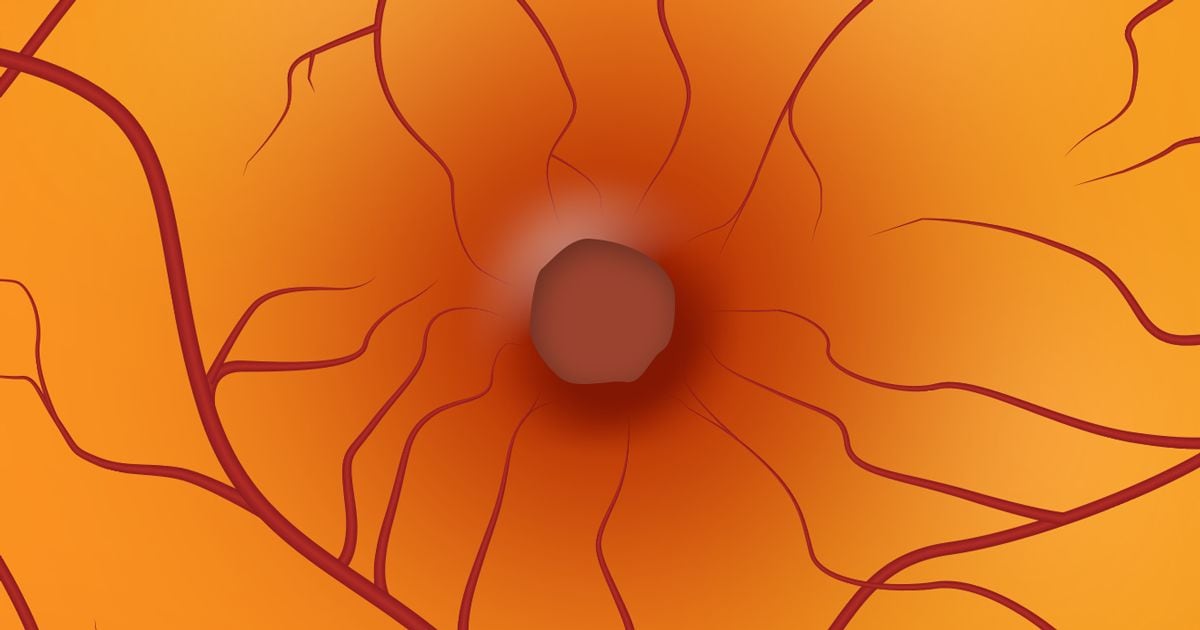 Macular Holes: Causes, Progression, and Surgery