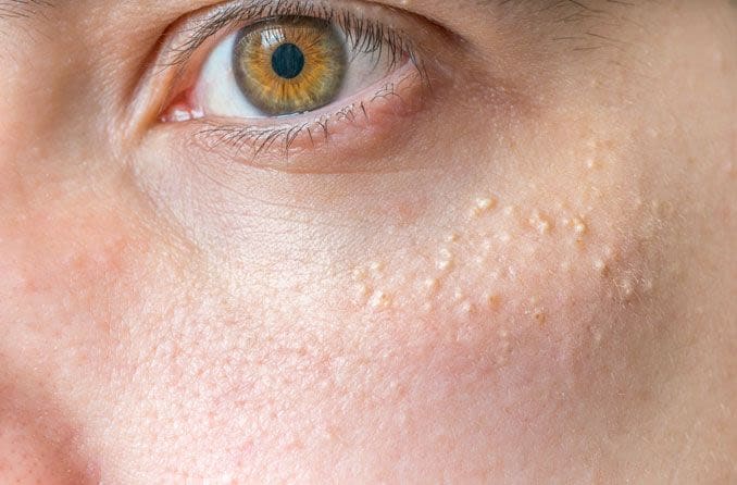 closeup of milia bumps on cheek below the eye