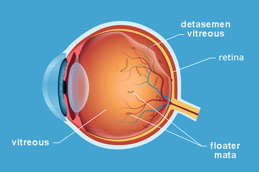 Detasemen vitreous dan floaters di dalam mata Detasemen vitreous dan floaters di dalam mata