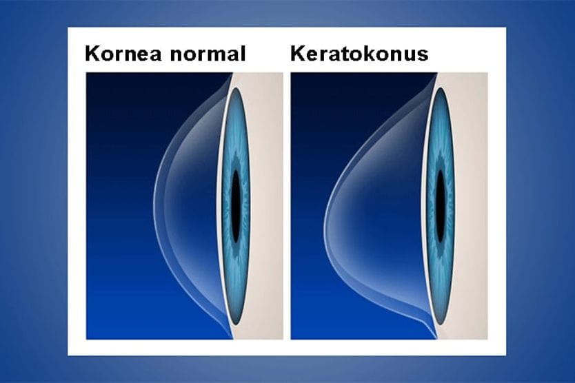Kornea normal vs. keratokonus Kornea normal vs. keratokonus