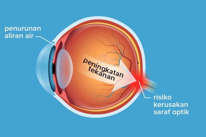 Ilustrasi diagram kondisi hipertensi okular Ilustrasi diagram kondisi hipertensi okular