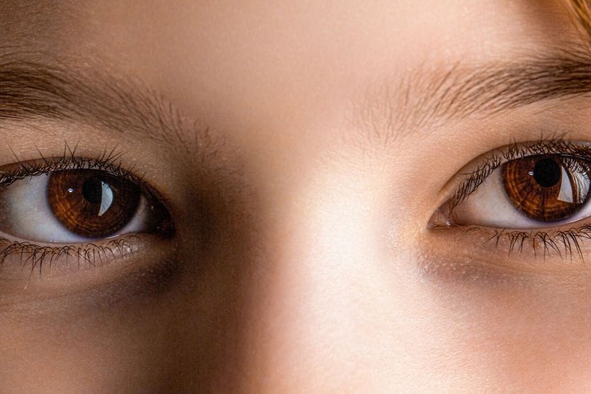 orang dengan strabismus