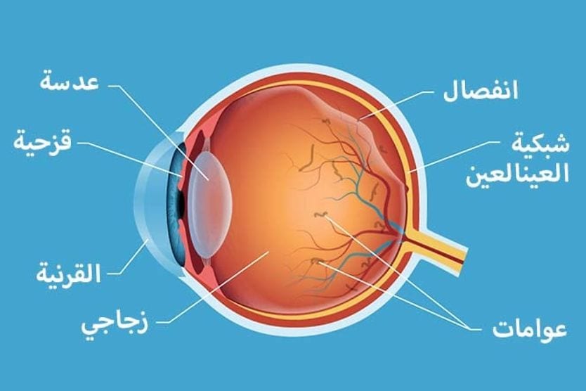انفصال الجسم الزجاجي والعوامات داخل العين