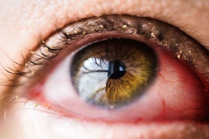 صورة مقربة لعين مصابة بالتهاب الملتحمة