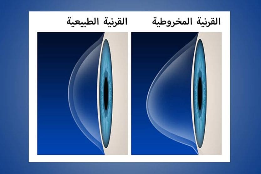 القرنية الطبيعية مقابل القرنية المخروطية