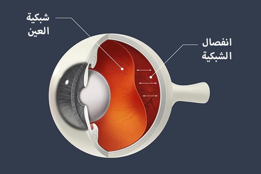مخطط انفصال الشبكية