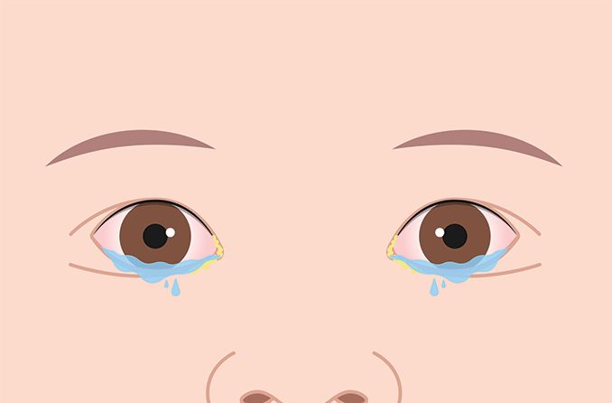 How to stop watery eyes or teary eyes