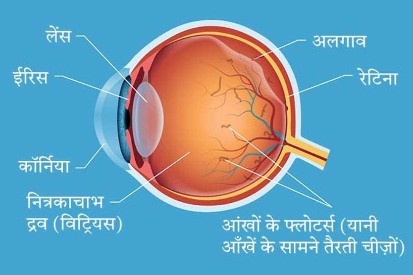 नेत्रों के भीतर विटेचर्स और फ्लोटर्स नेत्रों के भीतर विटेचर्स और फ्लोटर्स