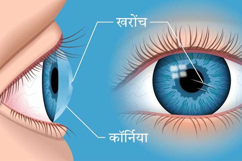 एक कॉर्नियल घर्षण का चित्रण एक कॉर्नियल घर्षण का चित्रण