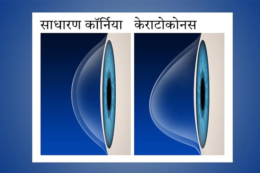 सामान्य कॉर्निया बनाम केराटोकोनस सामान्य कॉर्निया बनाम केराटोकोनस