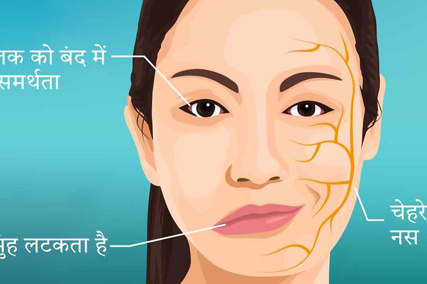 बेल के पक्षाघात के लक्षणों से पीड़ित महिला का चित्रण बेल के पक्षाघात के लक्षणों से पीड़ित महिला का चित्रण
