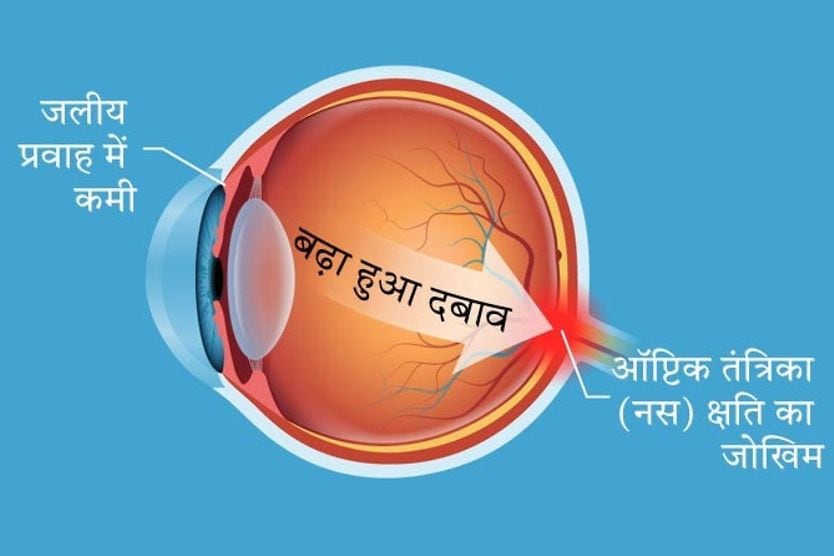 नेत्र उच्च रक्तचाप की स्थिति का आरेख चित्रण नेत्र उच्च रक्तचाप की स्थिति का आरेख चित्रण