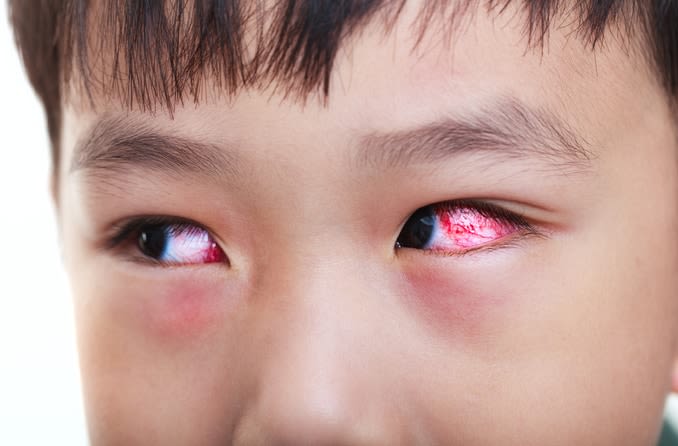 Young boy with red, inflamed eye