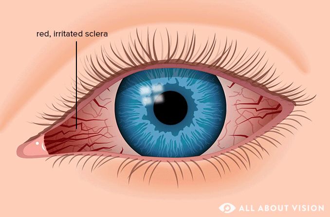 Eye redness (bloodshot eyes)