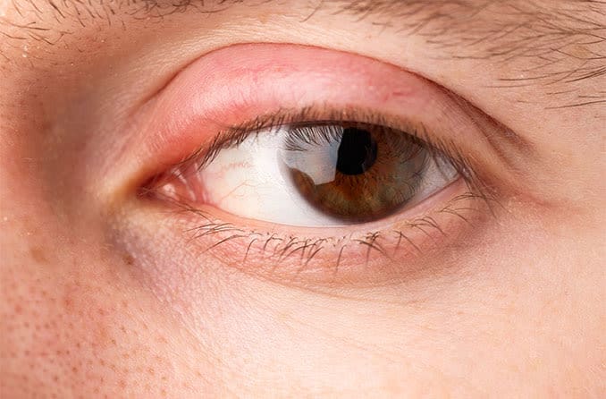 man with a swollen eyelid