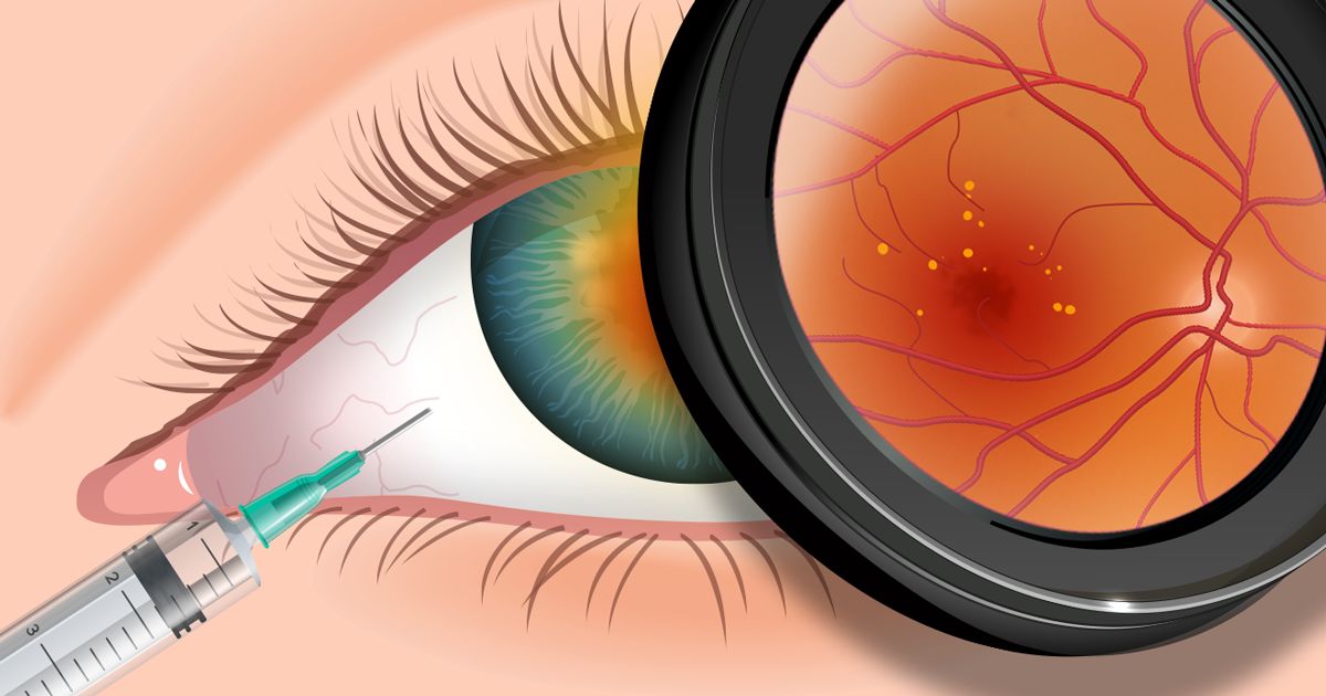 eye injection of lucentis or avastin