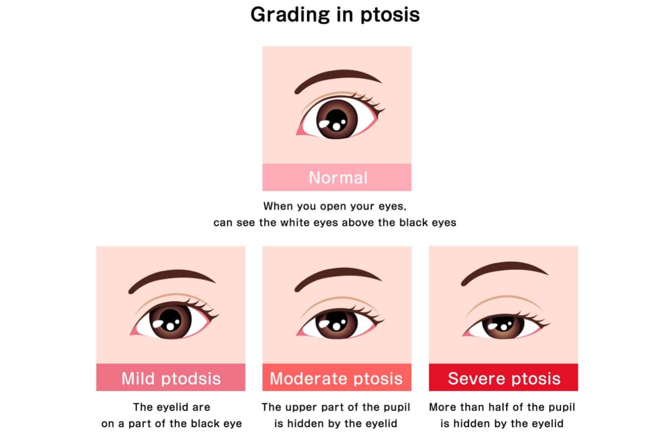 Ptosis grading illustration.