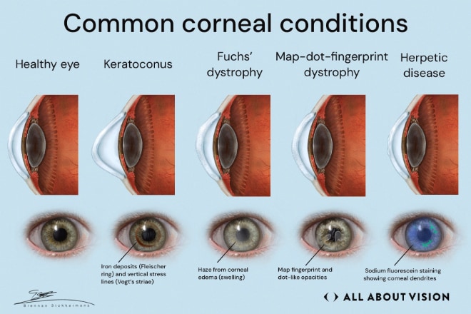 An overview of corneal diseases