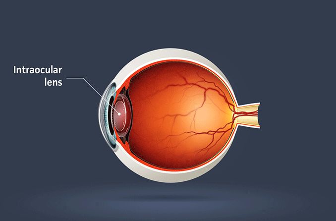 illustration of an iol on an eye diagram