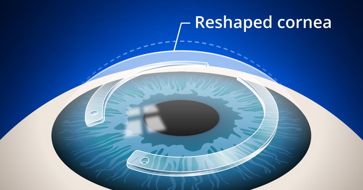 intacs corneal inserts procedure