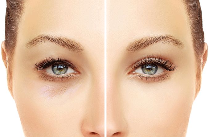 upper and lower eyelid blepharoplasty before and after pics