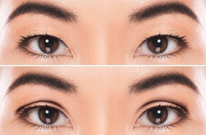 closeup of a set of asian eyes before and after undergoing double eyelid surgery