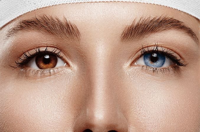 woman with an eye color change surgery with one blue eye and one brown eye