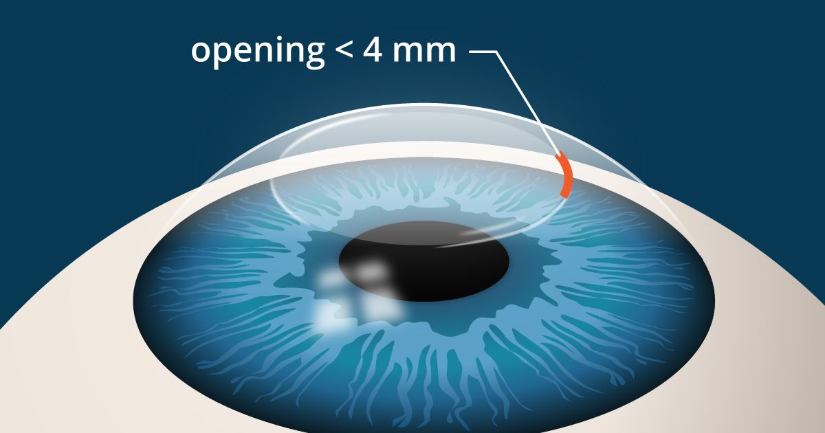 SMILE laser eye surgery