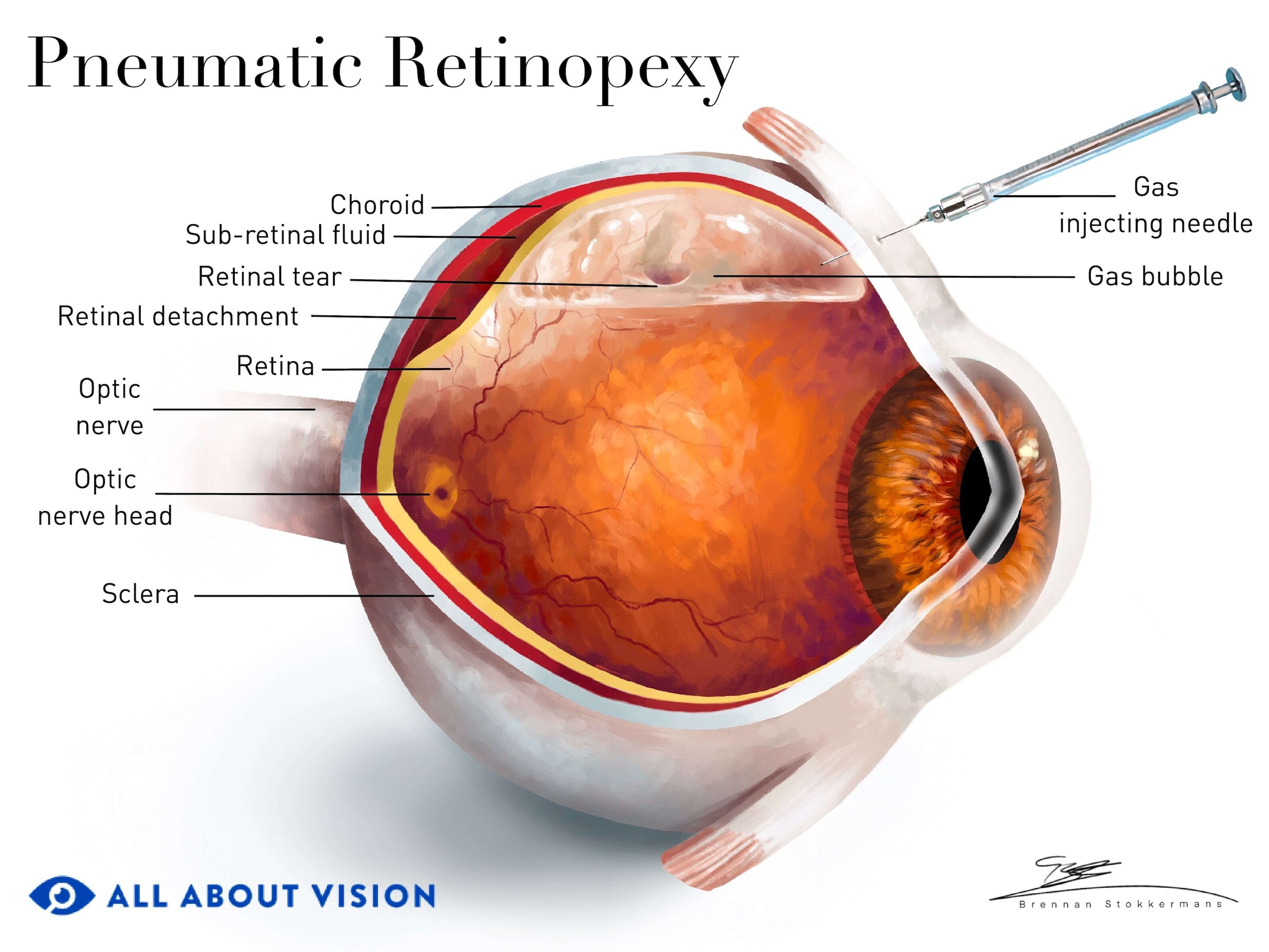 Image showcasing the anatomy of the eye, and what a detached retina looks like before pneumatic retinopexy surgery.