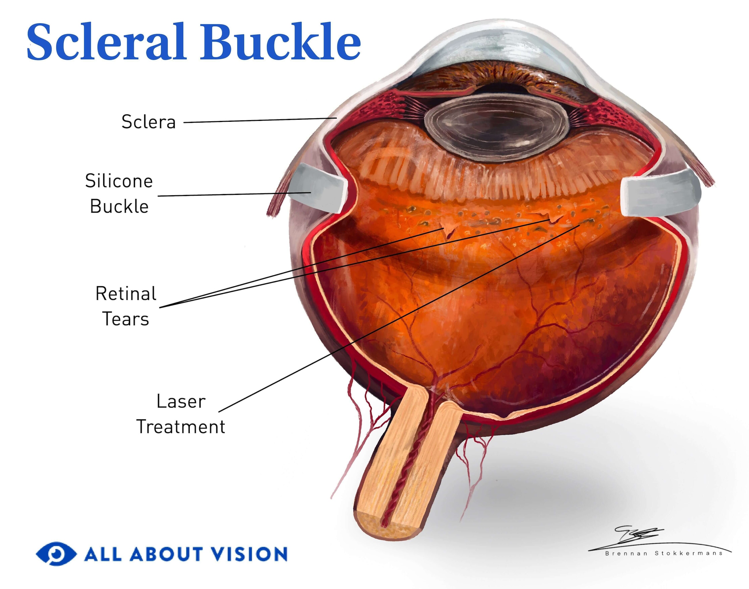 Illustration of elements that make up a scleral buckle