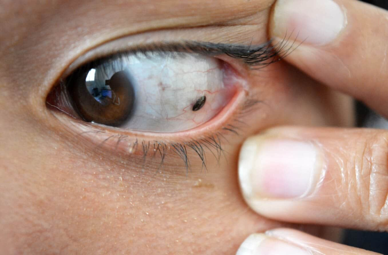 Close-up of suspicious mole on Asian woman's eye.