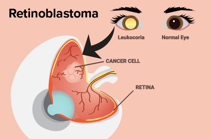 illustration of retinoblastoma