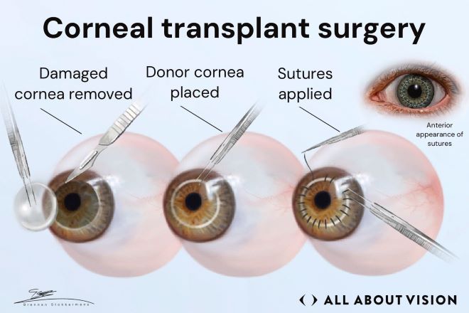 Corneal Transplant Surgery