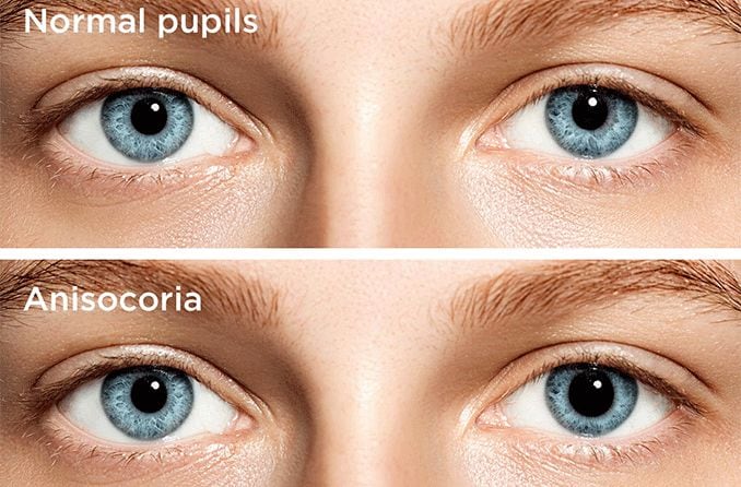 normal pupils vs person with adie's pupil (anisocoria)