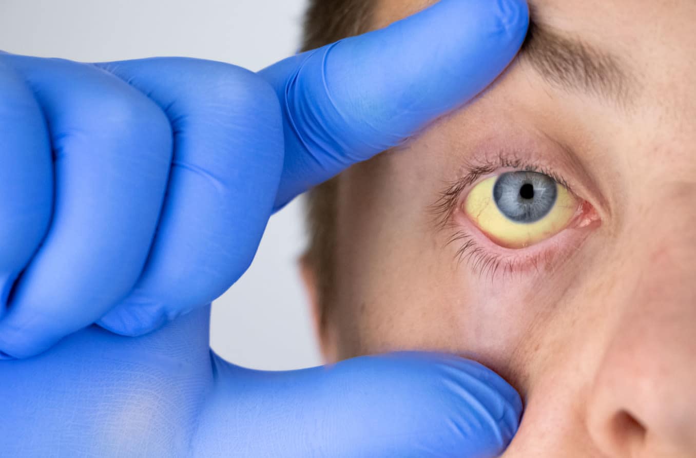 Understanding the impact of anemia on your eyes and vision